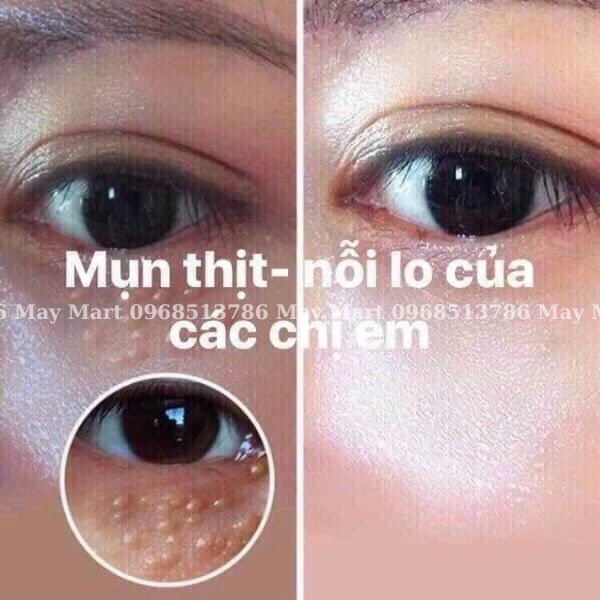 Kem trị mụn thịt Tsubuporon Eye Essence Nhật Bản