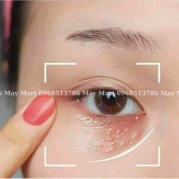 Kem trị mụn thịt Tsubuporon Eye Essence Nhật Bản